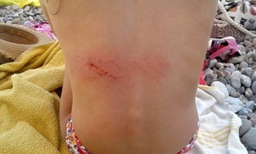 На пляже Коктебеля была ранена маленькая девочка